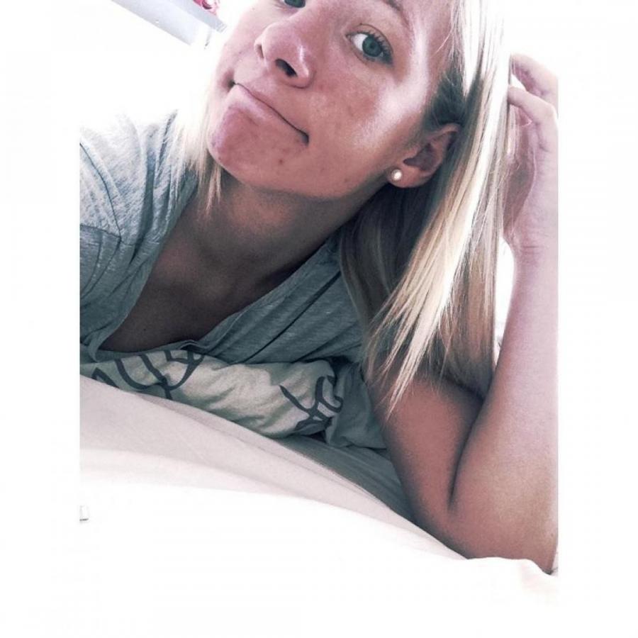 Acne selfie. Slide 11